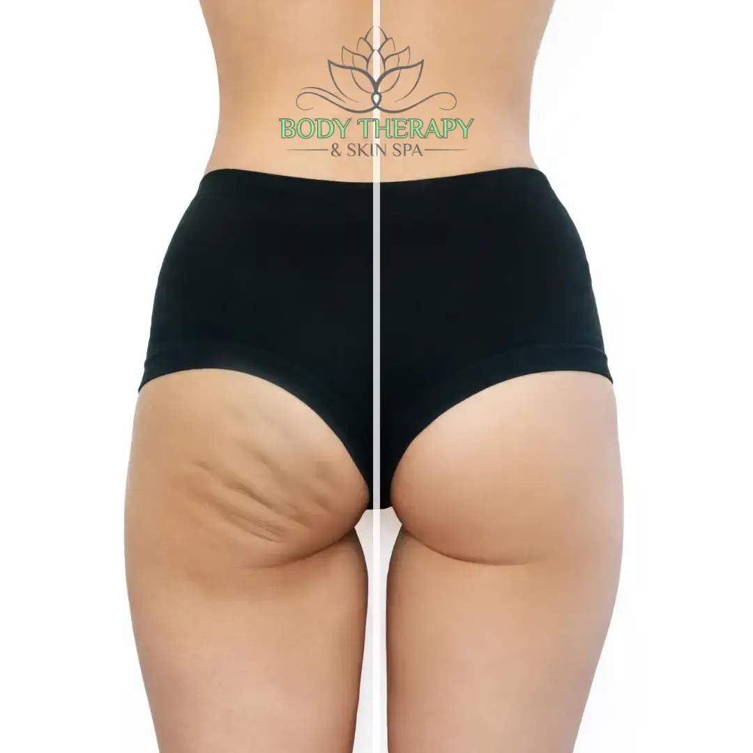 Which Treatments can help Reduce Cellulite?