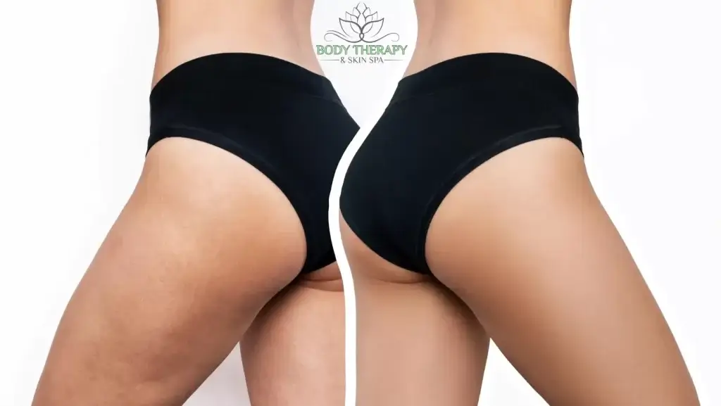 Cellulite Before and After